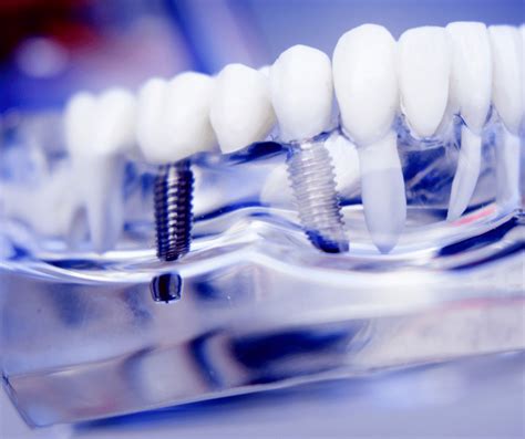 biocompatible dental care arvada, co|Dental Implants .